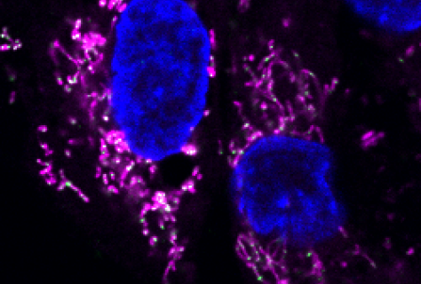 Mitochondrial DNA (green) escapes from the mitochondria (pink), causing an abnormal immune response