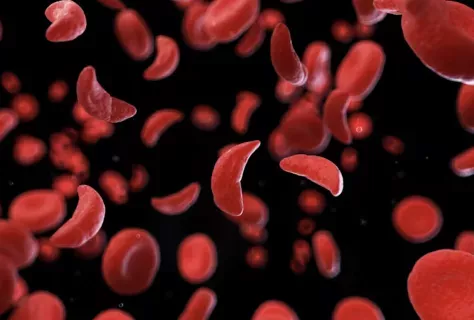 Drépanocytose