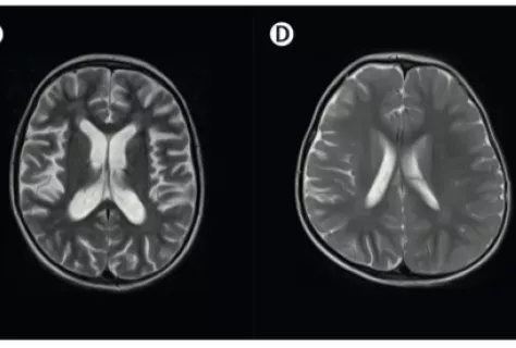 Découverte d’une nouvelle cause génétique d’inflammation du cerveau