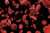 Drépanocytose