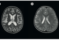 Découverte d’une nouvelle cause génétique d’inflammation du cerveau