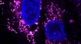 Mitochondrial DNA (green) escapes from the mitochondria (pink), causing an abnormal immune response