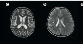 Découverte d’une nouvelle cause génétique d’inflammation du cerveau